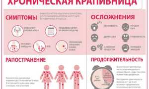 Крапивница – симптомы, причины появления, виды и лечение крапивницы
