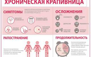 Крапивница – симптомы, причины появления, виды и лечение крапивницы