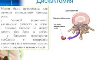 Как лечить невралгию седалищного нерва при беременности