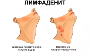 Увеличенные лимфоузлы – причины, симптомы, что делать и как лечить лимфоузлы