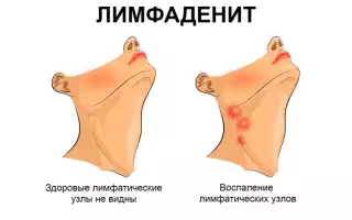 Увеличенные лимфоузлы – причины, симптомы, что делать и как лечить лимфоузлы